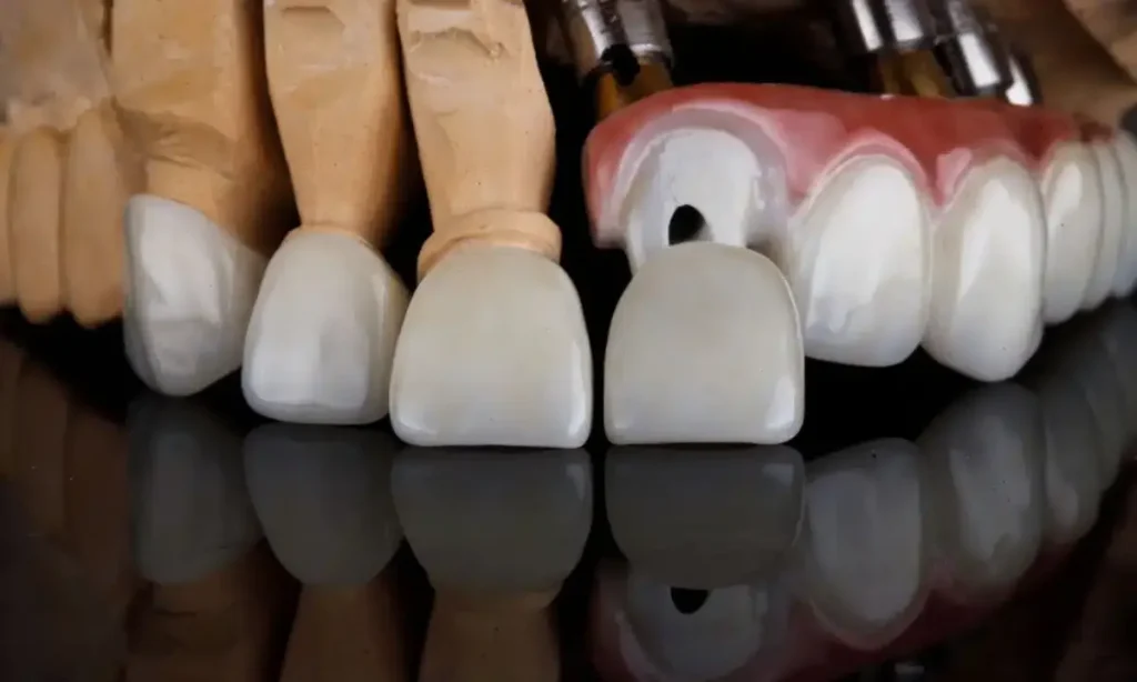 تفاوت کامپوزیت و لمینت