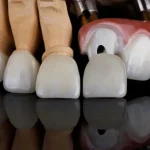 تفاوت کامپوزیت و لمینت