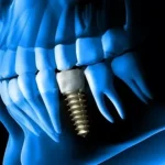 راهنمای ایمپلنت دندان