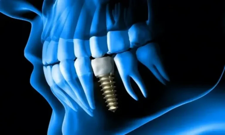 راهنمای ایمپلنت دندان