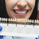 روکش دندان چیست