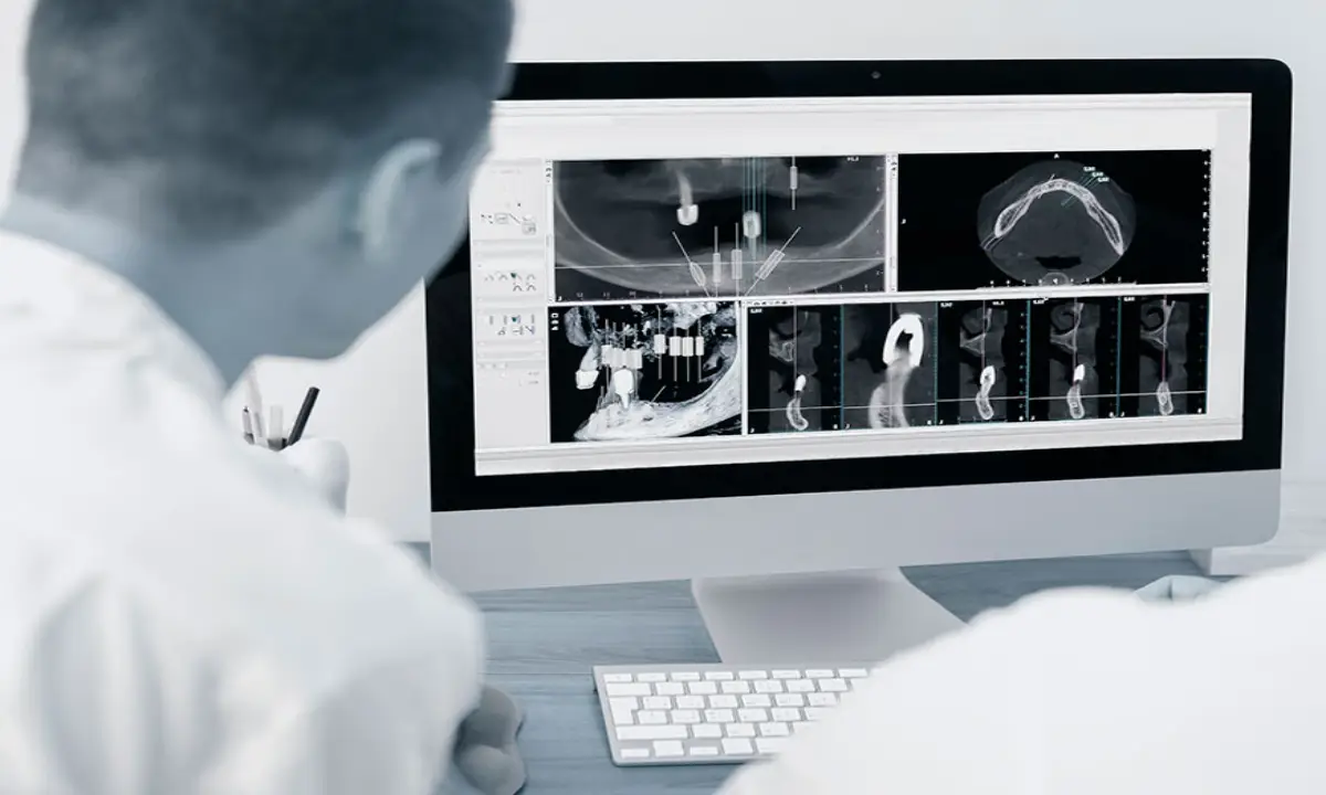 کاشت ایمپلنت دیجیتال