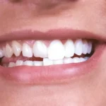 کامپوزیت دندان جلویی چیست؟