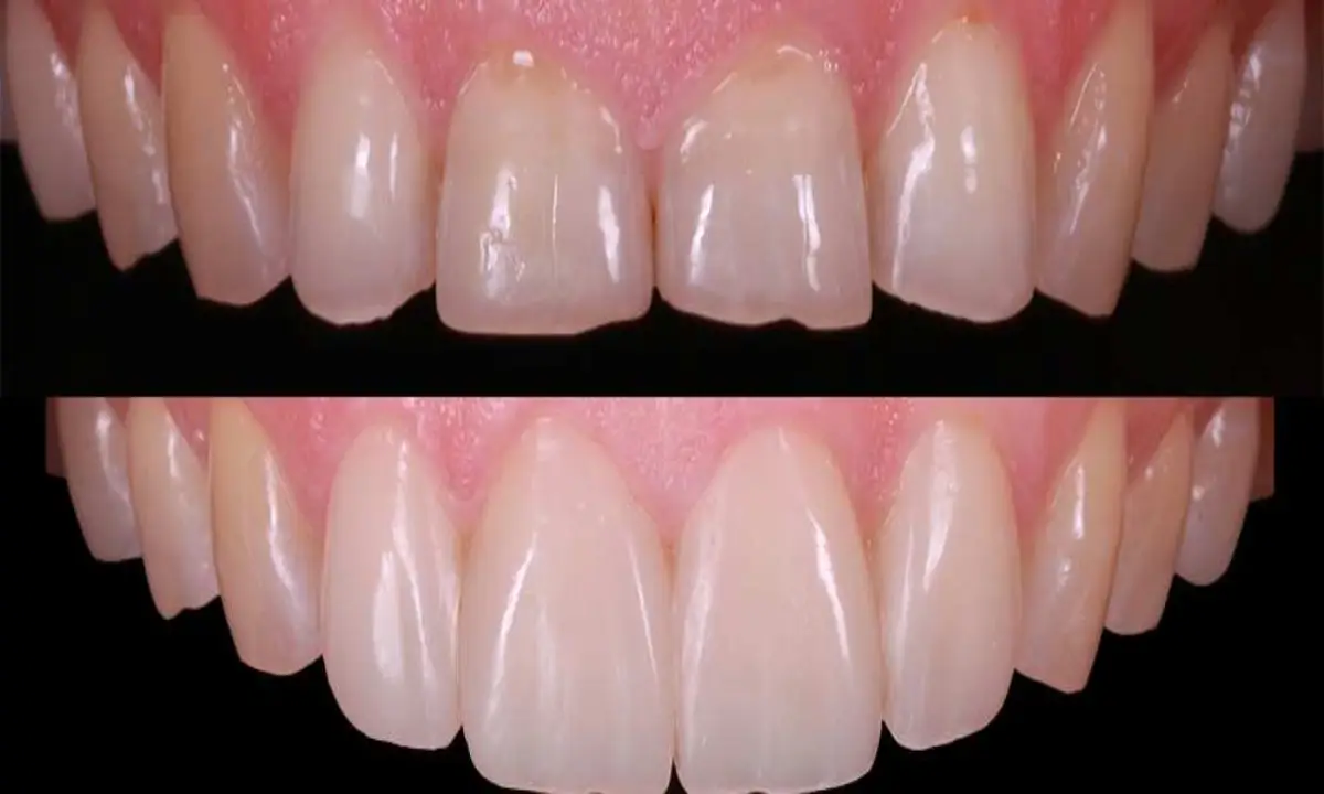 فرق کامپوزیت با لمینت